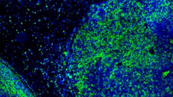 Tumorzellen werden von T-Zellen attackiert