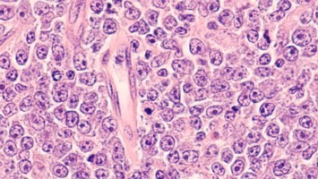 Diffus großzelliges B-Zell-Lymphom (DLBCL)
