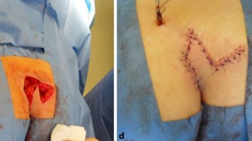 Operationstechnik der Limberg-Plastik bei Sinus pilonidalis