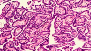 Histologische Aufnahme eines Patienten mit Schilddrüsenkarzinom