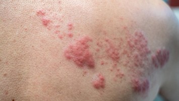 Herpes Zoster am Rücken