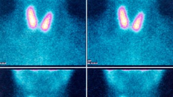 Szintigraphie der Schilddrüse mit zwei Knoten