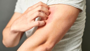 Eine Person, die sich juckt und kratzt