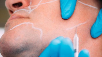 Fillerbehandlung im Gesicht eines Mannes