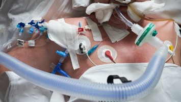 Intubierter Intensivpatient