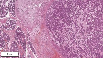 Histologie des Tumorpräparats in HE-Färbung: Speicheldrüsentumor