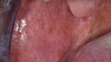 Graft-versus-Host-Disease in milder Ausprägung