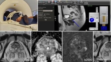 MRT(Magnetresonanztomographie)-(in-bore)-Biopsie der Prostata