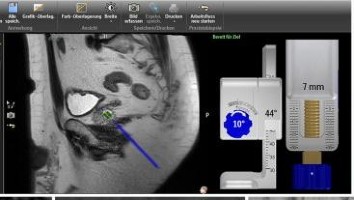 MRT(Magnetresonanztomographie)-(in-bore)-Biopsie der Prostata