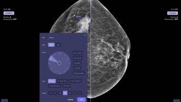 Computergestützte Auswertung einer Mammographie