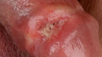 Fibrinbelegtes Ulkus bei der Erstvorstellung an der Glans Penis