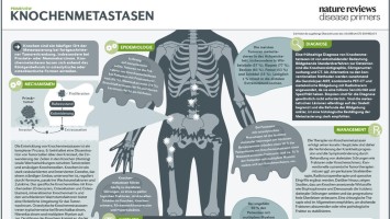 PrimeView Knochenmetastasen