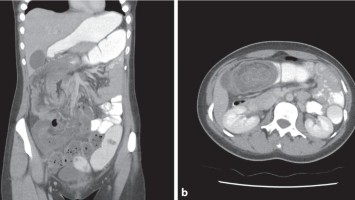 CT bei Invagination des terminalen Ileums in das Colon ascendens