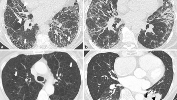 Bildgebung verschiedener interstitieller Lungenerkrankungen
