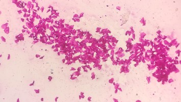 Gram-positiver Abstrich bei bakterieller Vaginose 