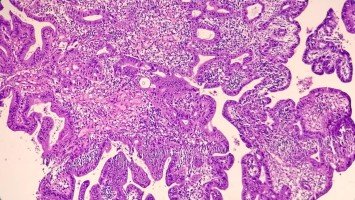 Adenokarzinom der Prostata