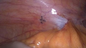 Peritoneale Endometrioseherde