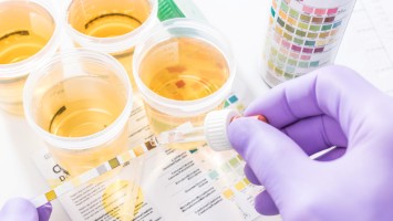 Laborkraft benetzt einen Urinteststreifen