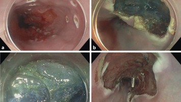 Short-Segment-Barrett-Ösophagus mit submukosalem Adenokarzinom