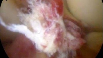 Vordere Kreuzbandruptur