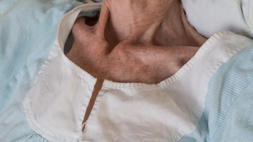 Hals und Schultern einer sehr mageren Frau