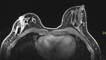 Rezidivierender ipsilateraler Brustkrebs bei Lynch-Syndrom