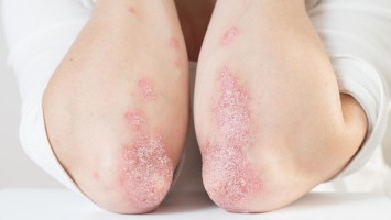 Entzündliche Plaques am Ellenbogen bei Psoriasis