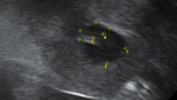 Querschnitt der rechten Tube mit tamponierendem Koagel