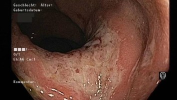 Distale Proktitis mit purulenten Auflagerungen