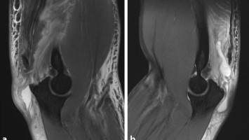 Magnetresonanztomographie: distale Trizepssehnenruptur