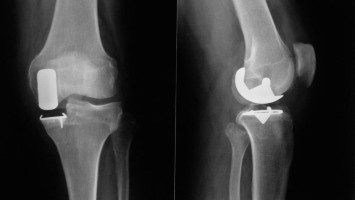 Unikompartimentelle Knieprothese