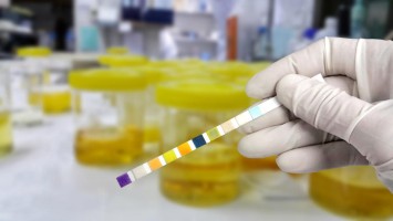 Teststreifen zur Urin-Analyse