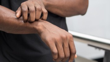 Person kratzt sich am Arm