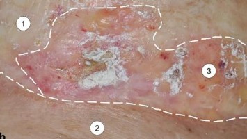Postradiogene Morphea