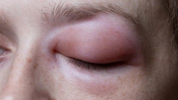 Titelbild: Hereditäres Angioödem