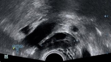 Präoperativer sonographischer Befund mit Verdacht auf Saktosalpinx rechts