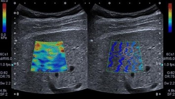 Leber-Elastographie bei Patient mit Leberzirrhose