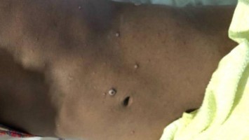 Initiales Bild der papulösen Hautveränderungen