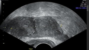 Transvaginalsonographie bei Uterus bicornis bicollis