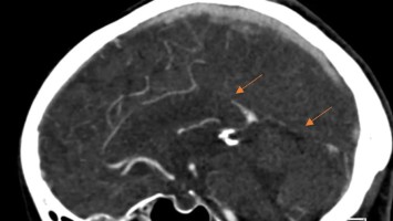 Venöse CT-Angiografie: Sinusthrombose