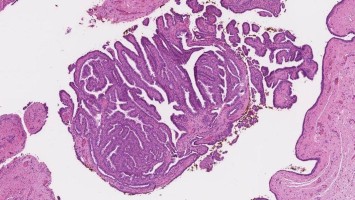 Histologische Darstellung des Hidradenoma papilliferum
