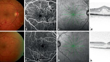Nichtproliferative diabetische Retinopathie