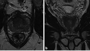 Multiparametrische MRT der Prostata