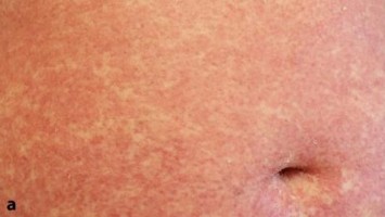 „Drug reaction with eosinophilia and systemic symptoms“ (DRESS) Hauterscheinungen