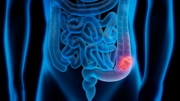 Modell Tumor gastrointestinal