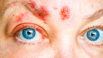 Herpes Zoster im Gesicht