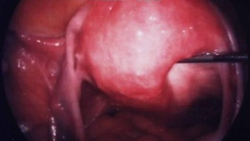 Klinisches Bild einer Adenomyose & floride Peritonealendometriose