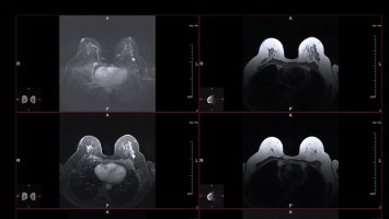 Magnetresonanztomographie der Brust