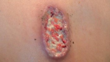 Multilokuläres Pyoderma gangraenosum durch Levamisolgestrecktes Kokain