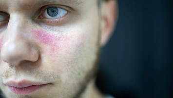 Lupus